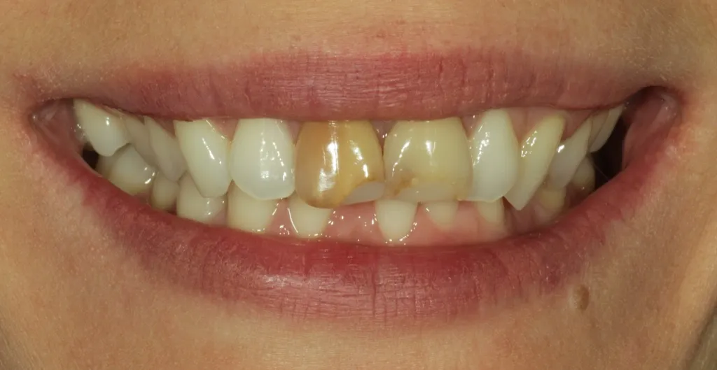 Dunkle, verfärbte Zähne vor der Versorgung mit Non-Prep Veneers