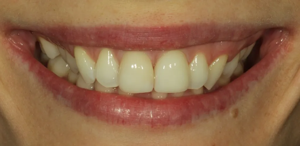 Aufgehellte Zähne nach kosmetischer Korrektur mit Non-Prep Veneers