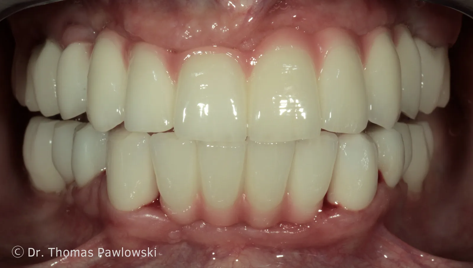 Ober- und Unterkiefer nach Gesamtsanierung mit fixen Zirkonbrücken auf zwölf schablonengeführten Implantaten