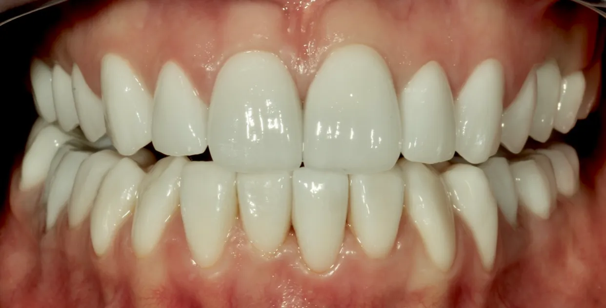 Frontzähne nach dauerhafter Überdeckung der Verfärbungen mit Non-Prep Veneers