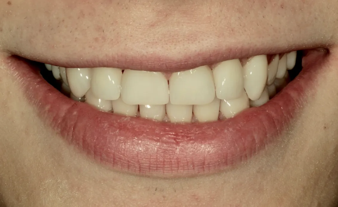 Geschlossene Zahnlücke nach Versorgung mit Non-Prep Veneers