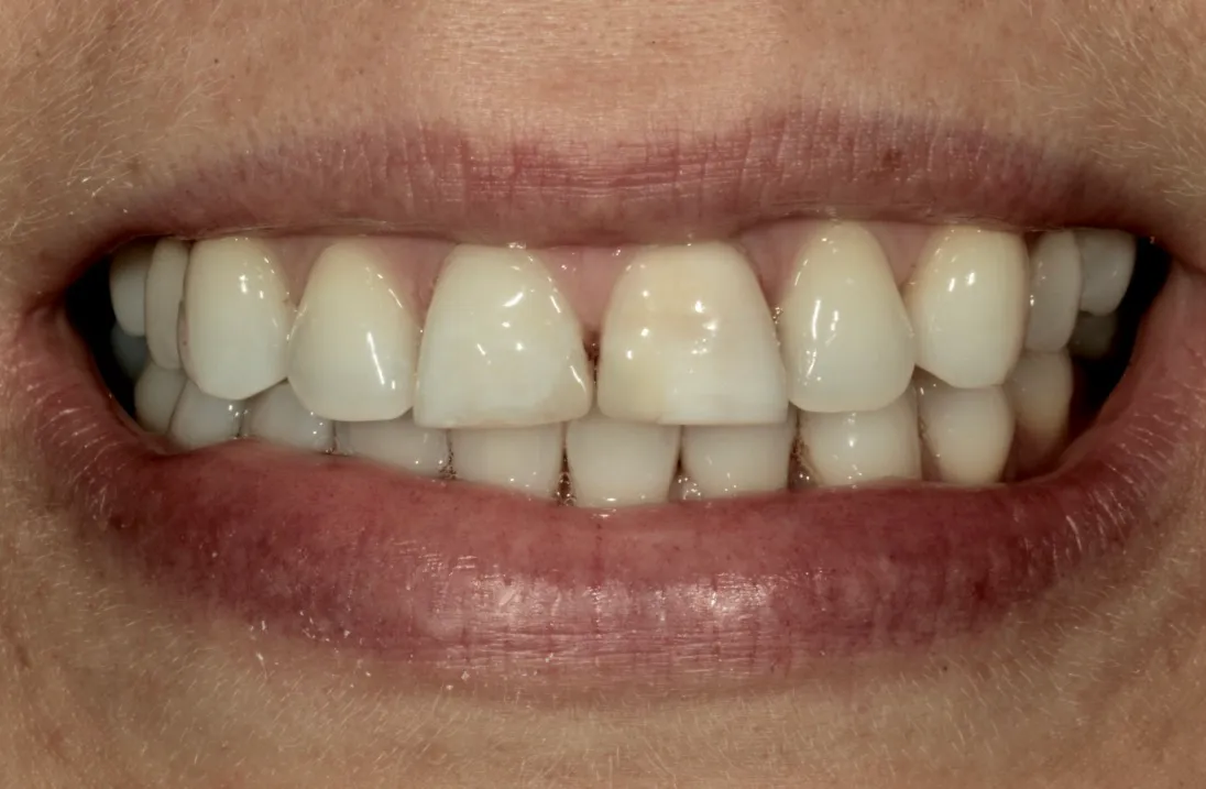 Frontzahnform vor der Versorgung mit Non-Prep Veneers
