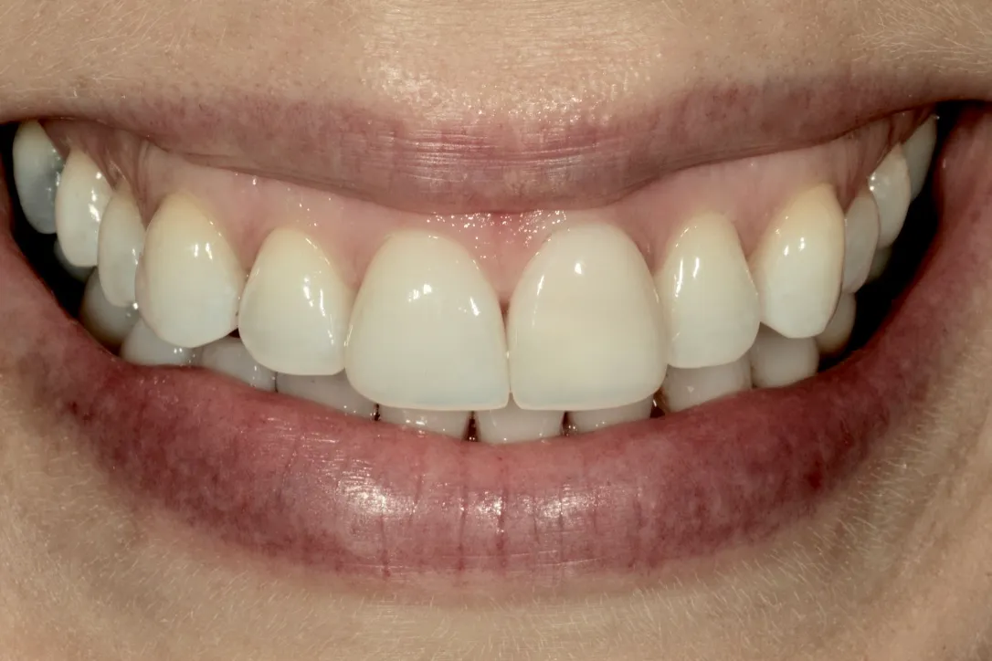 Veränderte Frontzahnform nach Versorgung mit Non-Prep Veneers