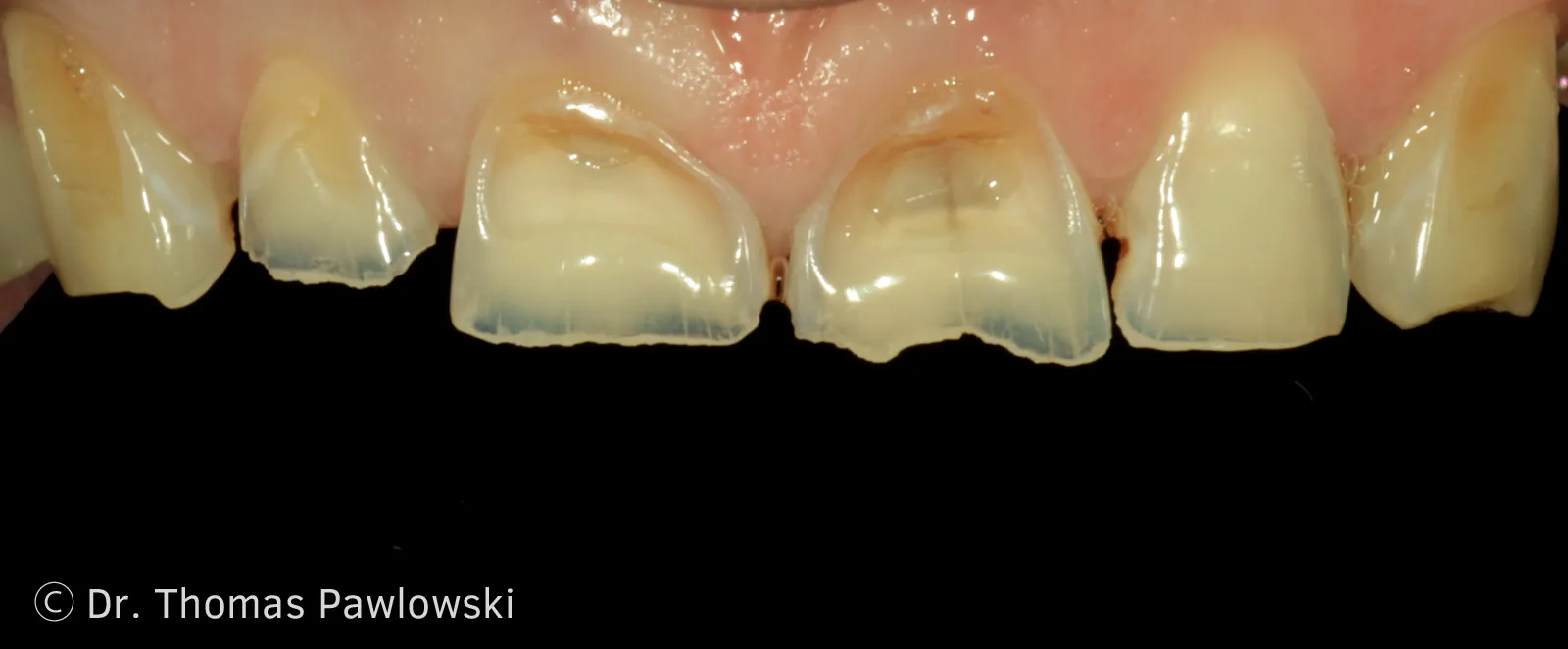 Heavily worn, unsightly front teeth before reconstruction