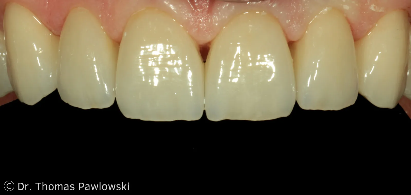 Front teeth after reconstruction with six biocompatible full-ceramic single crowns
