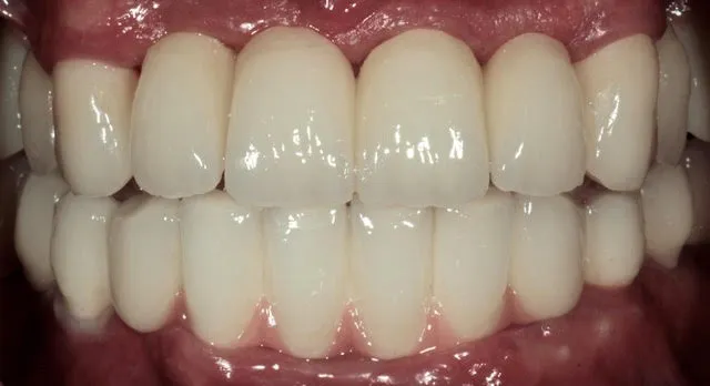 Gesamtsanierung von Ober- und Unterkiefer mit insgesamt 8 computernavigierten Implantaten, Zirkonbrücken und Kronen, mit teilweisem Erhalt der vorhandenen Zähne — Nachher
