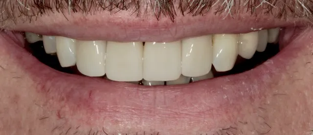 4 Non-Prep Veneers auf den Zähnen 12–22 — Nachher
