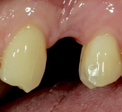 Computernavigierte Implantate — Vorher