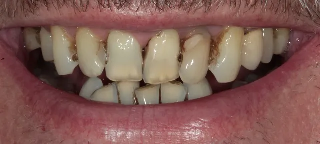 Non-Prep Veneers — Vorher
