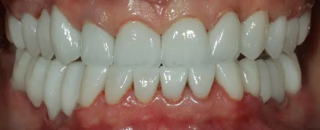 Gesamtsanierung von Ober- und Unterkiefer mit vollkeramischen Kronen, Non-Prep Veneers und computernavigierten Implantaten — Nachher