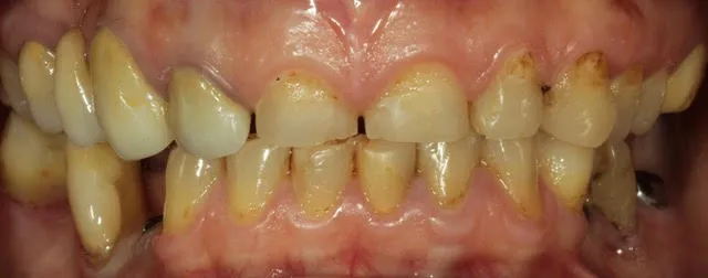 Gesamtsanierung von Ober- und Unterkiefer mit vollkeramischen Kronen, Non-Prep Veneers und computernavigierten Implantaten — Vorher