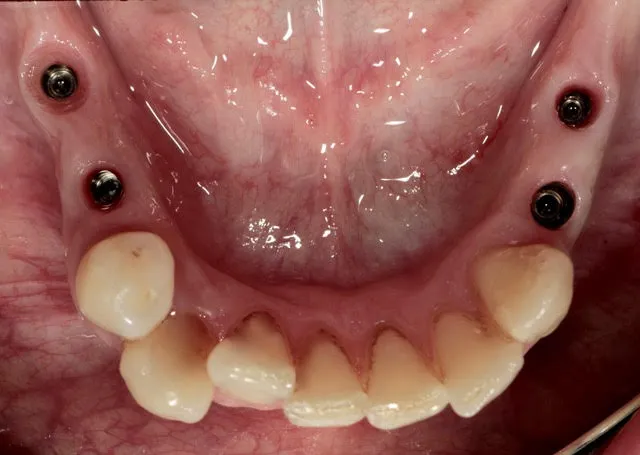 Zwei Seitenzahnbrücken auf vier computernavigierten Implantaten im Unterkiefer-Seitenzahnbereich — Ausgangssituation