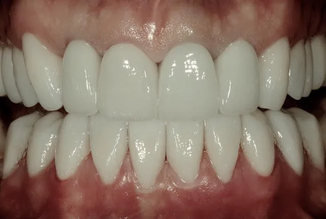 Gesamtversorgung von Ober- und Unterkiefer: Erneuerung der vorhandenen Metallkeramikkronen durch metallfreie, vollkeramische Kronen und Non-Prep Veneers — Nachher
