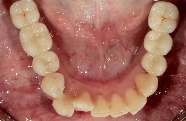 Zwei Seitenzahnbrücken auf vier computernavigierten Implantaten im Unterkiefer-Seitenzahnbereich — Ergebnis