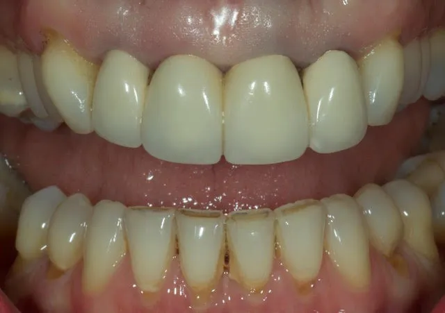 Gesamtversorgung von Ober- und Unterkiefer: Erneuerung der vorhandenen Metallkeramikkronen durch metallfreie, vollkeramische Kronen und Non-Prep Veneers — Vorher