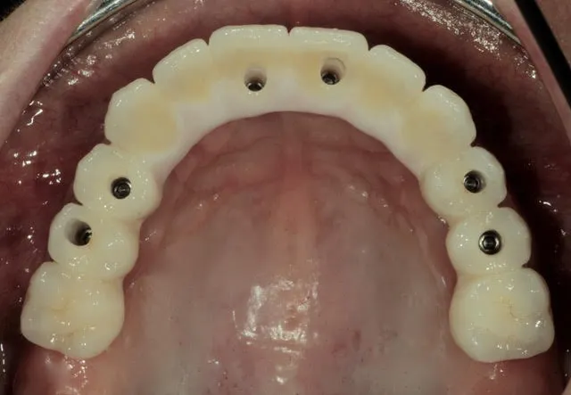 Fixe Zirkonbrücke im Oberkiefer auf sechs computernavigierten Implantaten — Behandlung
