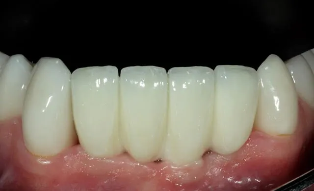 Frontzahnbrücke auf zwei computernavigierten Implantaten im Unterkiefer-Frontzahnbereich — Ergebnis
