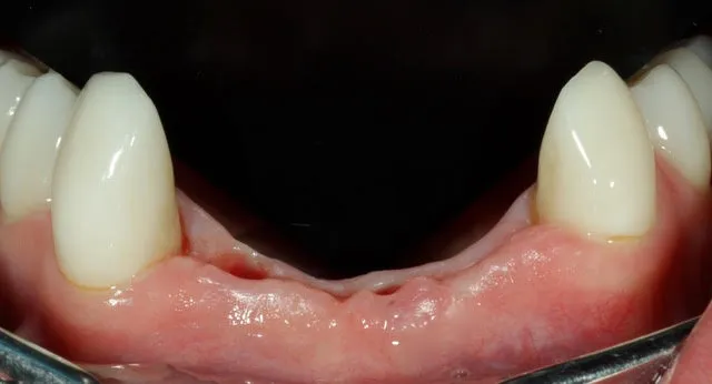 Frontzahnbrücke auf zwei computernavigierten Implantaten im Unterkiefer-Frontzahnbereich — Ausgangssituation