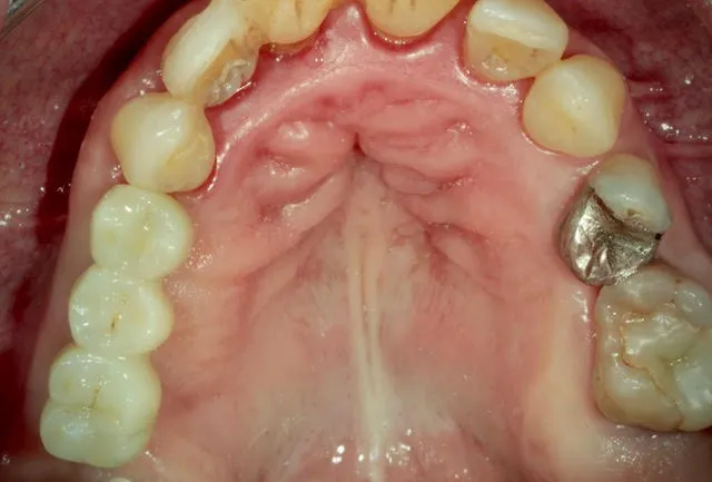 Seitenzahnbrücke auf zwei computernavigierten Implantaten im Oberkiefer-Seitenzahnbereich — Ergebnis