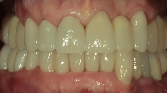 Gesamtsanierung von Ober- und Unterkiefer mit vollkeramischen Kronen, Non-Prep Veneers und 4 computernavigierten Implantaten — Nachher
