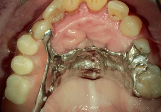 Seitenzahnbrücke auf zwei computernavigierten Implantaten im Oberkiefer-Seitenzahnbereich — Ausgangssituation