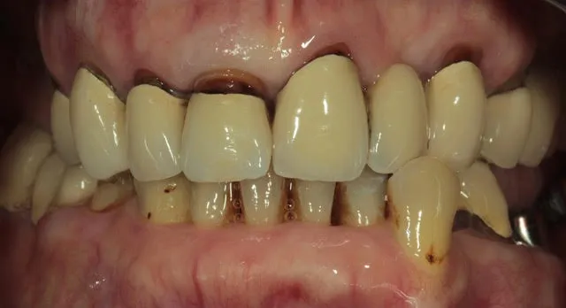 Gesamtsanierung von Ober- und Unterkiefer mit vollkeramischen Kronen, Non-Prep Veneers und 4 computernavigierten Implantaten — Vorher