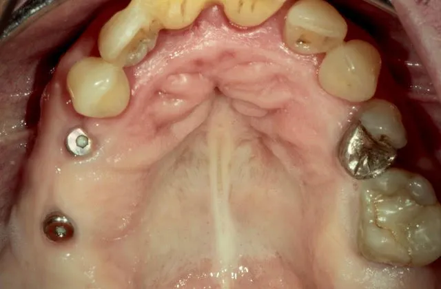 Seitenzahnbrücke auf zwei computernavigierten Implantaten im Oberkiefer-Seitenzahnbereich — Behandlung