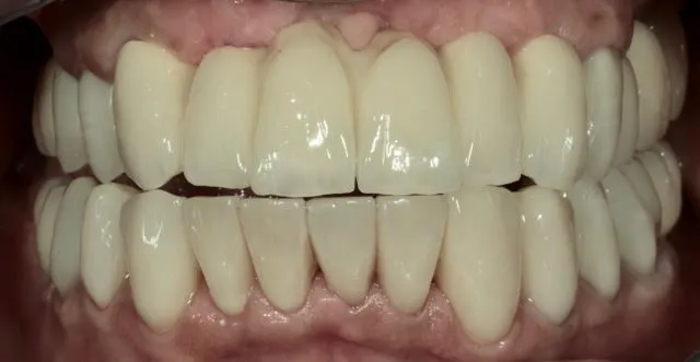 Gesamtsanierung von Ober- und Unterkiefer mit vollkeramischen Kronen, Non-Prep Veneers und 1 computernavigierten Implantat — Nachher