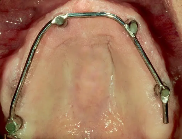 Stegprothese auf vier computernavigierten Implantaten im Oberkiefer — Ausgangssituation