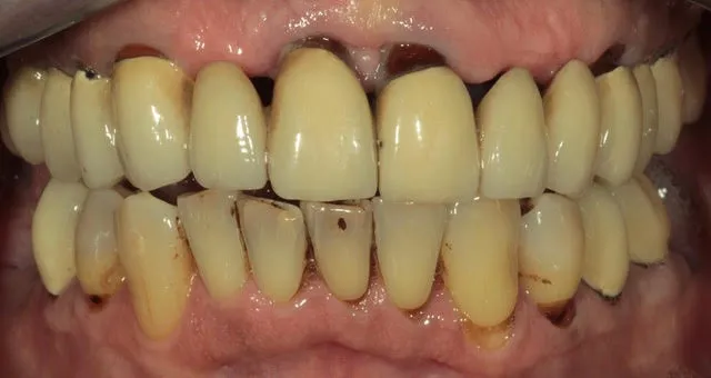 Gesamtsanierung von Ober- und Unterkiefer mit vollkeramischen Kronen, Non-Prep Veneers und 1 computernavigierten Implantat — Vorher