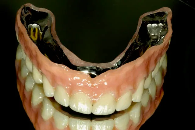 Stegprothese auf vier computernavigierten Implantaten im Oberkiefer — Behandlung