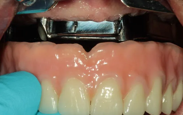 Stegprothese auf vier computernavigierten Implantaten im Oberkiefer — Behandlung