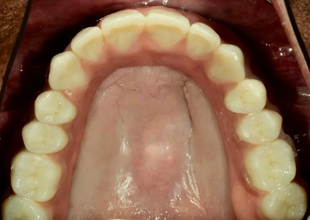 Stegprothese auf vier computernavigierten Implantaten im Oberkiefer — Behandlung