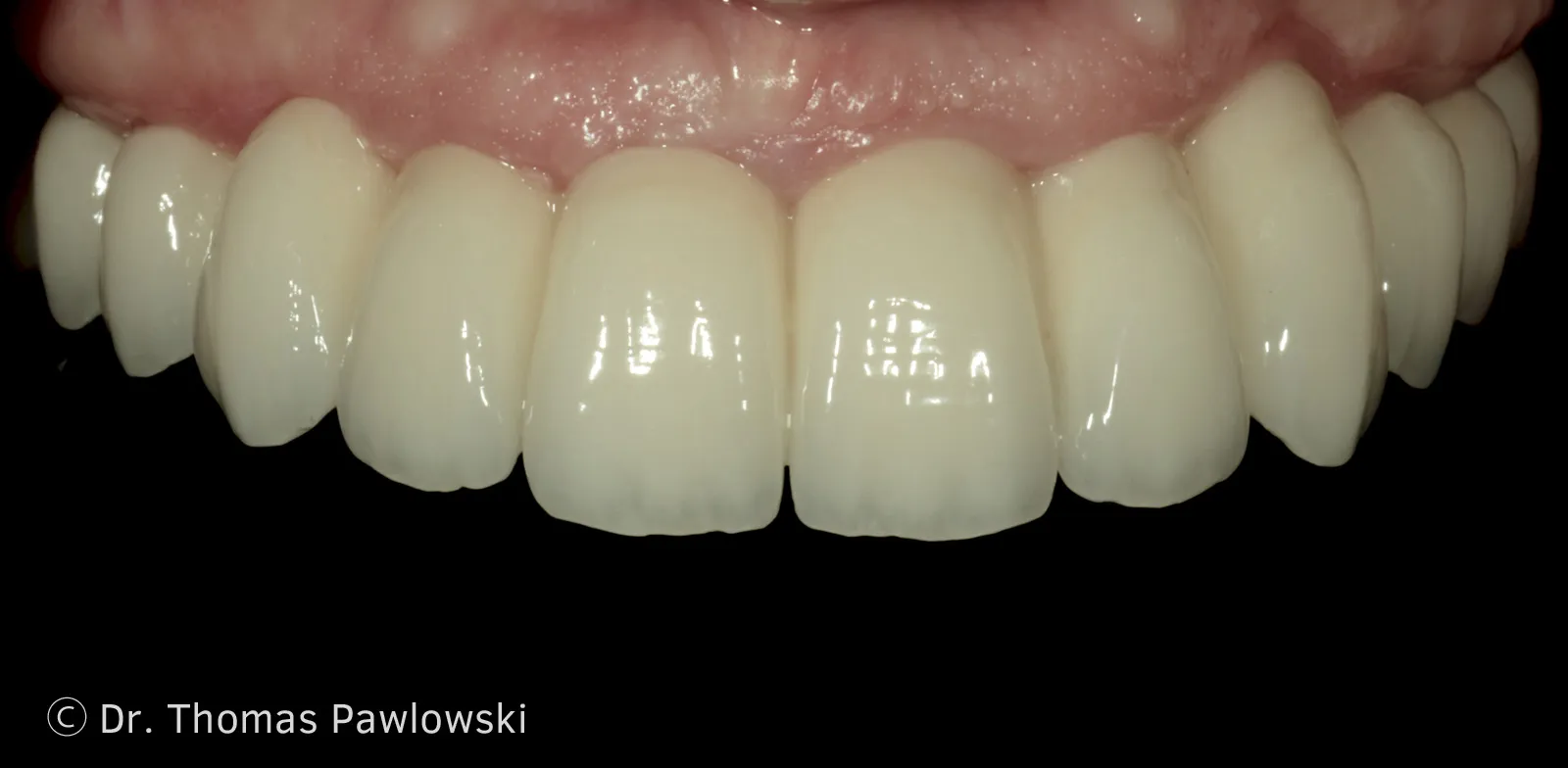 Oberkiefer nach schablonengeführter Implantation von sechs Implantaten und festsitzender vollkeramischer Procera-Implantatbrücke