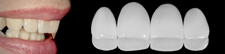 Non-prep Micro Veneers in Wien
